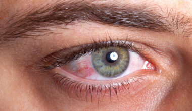 Fique atento às alergias oculares