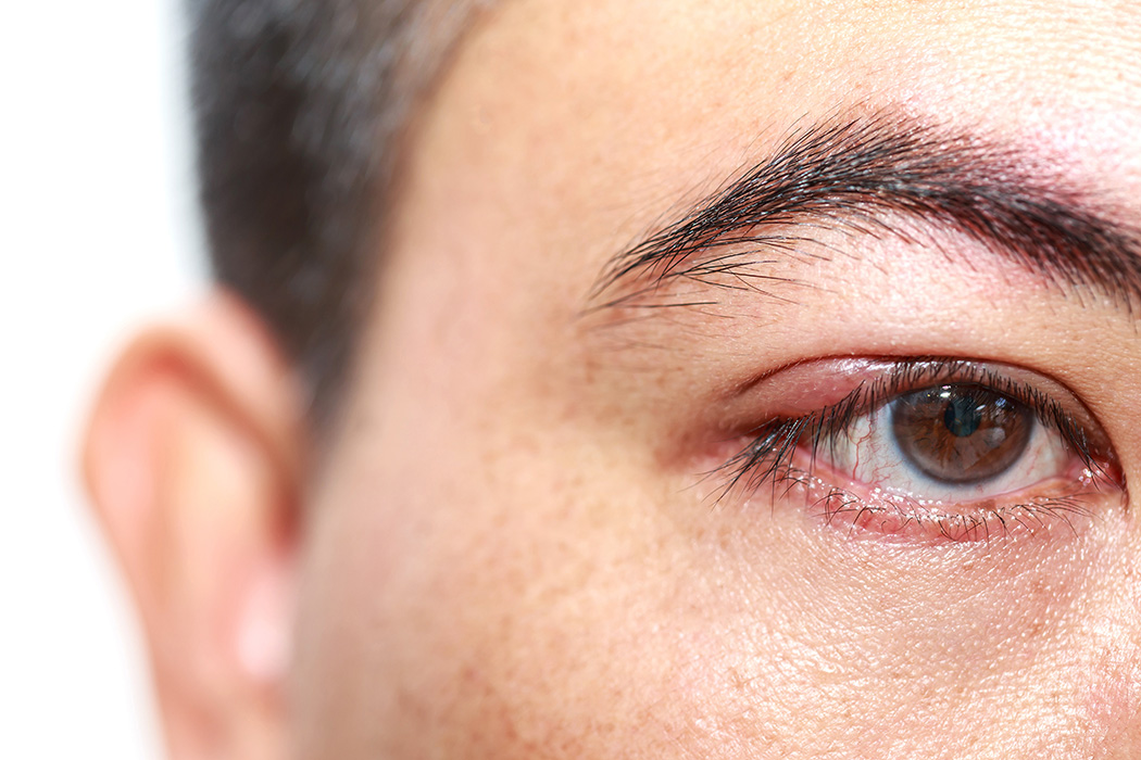 Terçol no olho: 6 causas e tratamento para o hordéolo