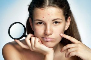 Quais são os tratamentos mais adequados para marcas de acne?