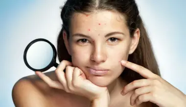 Quais são os tratamentos mais adequados para marcas de acne?