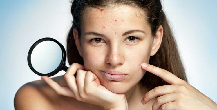 Quais são os tratamentos mais adequados para marcas de acne?