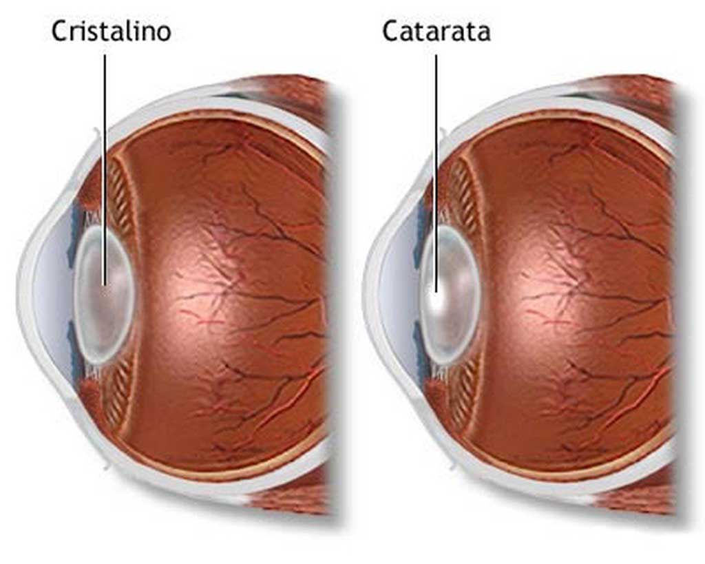 После лечения катаракты. Кортикальная катаракта.