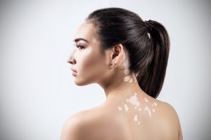 Vitiligo: o que é, sintomas e como tratar