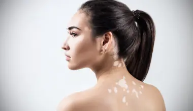 Vitiligo: o que é, sintomas e como tratar