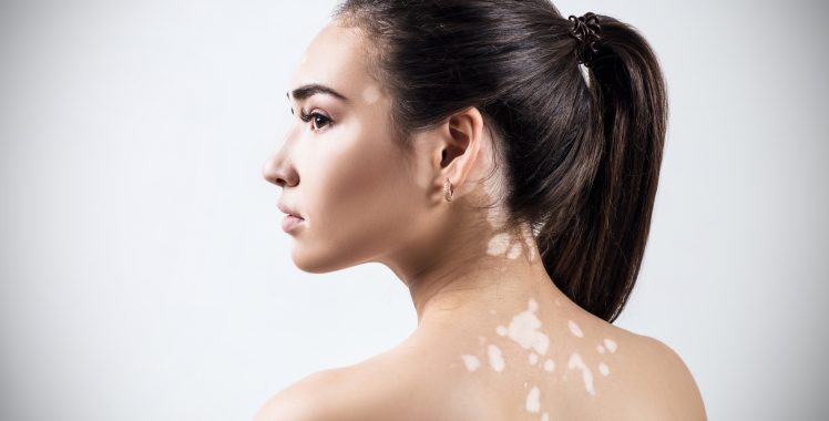 Vitiligo: o que é, sintomas e como tratar