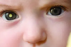 Retinoblastoma: 50% dos casos são diagnosticados tardiamente