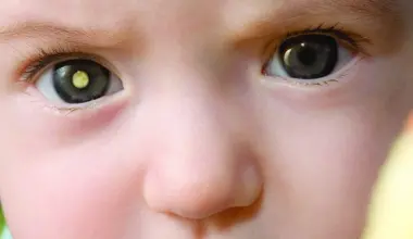 Retinoblastoma: 50% dos casos são diagnosticados tardiamente