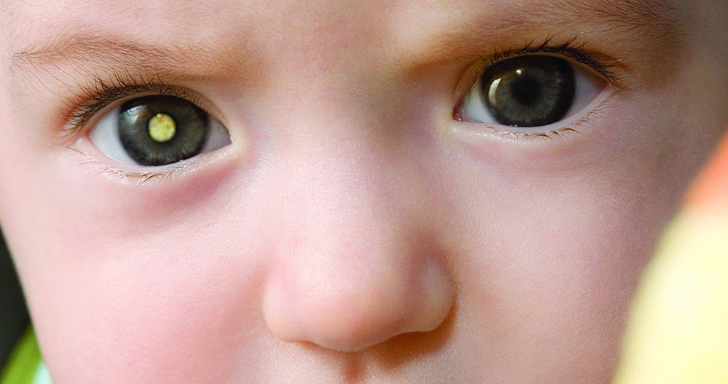 Retinoblastoma 50 Dos Casos São Diagnosticados Tardiamente Dermavisus